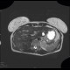Focal nodular hyperplasia, liver, T2W: MRI - Magnetic Resonance Imaging
